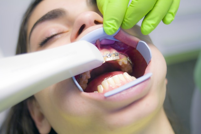 How Much Is Teeth Bonding