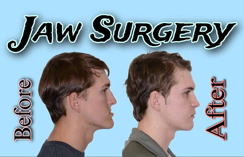 Jaw Surgery Before and After –Advanced Treatment/Health Benefits