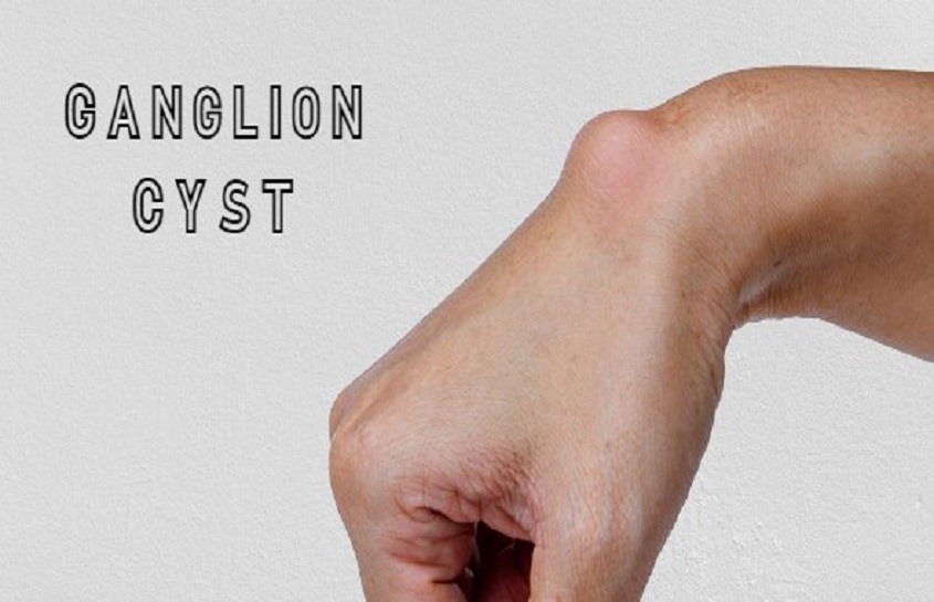 Ganglion Cyst Vitamin Deficiency Syndrome – Causes/Symptoms and Treatment